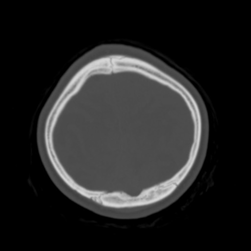 File:Cerebral tuberculosis with dural sinus invasion (Radiopaedia 60353-68018 Axial bone window 54).jpg