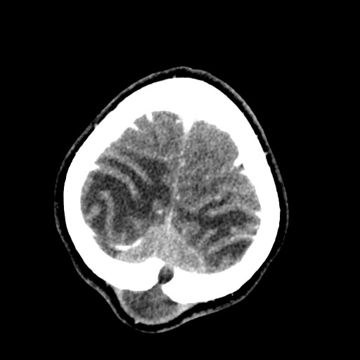 Cerebral tuberculosis with dural sinus invasion (Radiopaedia 60353-68019 Axial C+ delayed 59).jpg