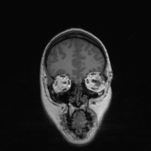 Cerebral tuberculosis with dural sinus invasion (Radiopaedia 60353-68090 Coronal T1 43).jpg