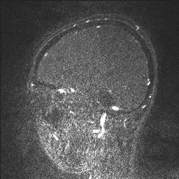Cerebral tuberculosis with dural sinus invasion (Radiopaedia 60353-68090 Sagittal MRV 112).jpg