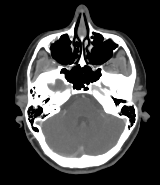 Cerebral venous hemorrhagic infarction (Radiopaedia 38461-40550 Axial MIP VENOGRAM 14).png