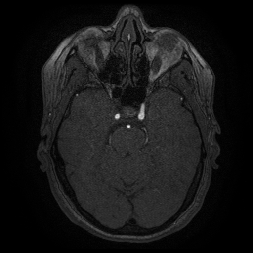 Cerebral venous infarction (Radiopaedia 25109-25363 MRA 8).jpg