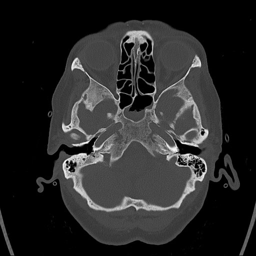 Cerebral venous infarction with hemorrhage (Radiopaedia 65343-74381 Axial bone window 19).jpg