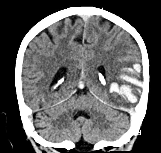 Cerebral venous infarction with hemorrhage (Radiopaedia 65343-74381 Coronal non-contrast 38).jpg