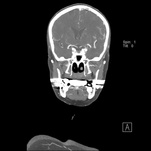 Cerebral venous infarction with hemorrhage (Radiopaedia 65343-74396 B 127).jpg