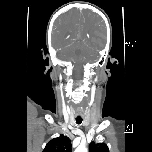 File:Cerebral venous infarction with hemorrhage (Radiopaedia 65343-74396 B 191).jpg