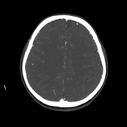 Cerebral venous sinus thrombosis (Radiopaedia 40619-43227 A 160).jpg