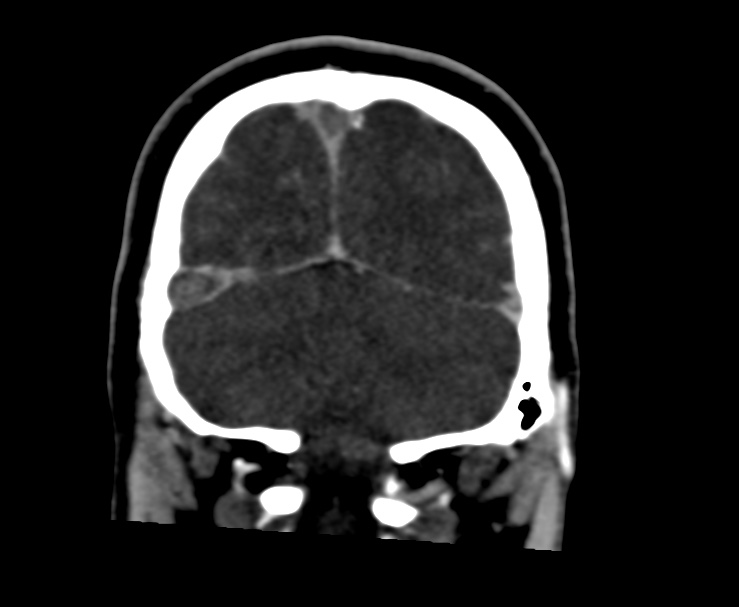 Cerebral venous sinus thrombosis (Radiopaedia 59224-66646 Coronal C+ delayed 65).jpg