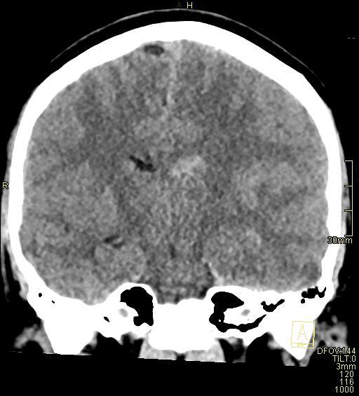 Cerebral venous sinus thrombosis (Radiopaedia 91329-108965 Coronal non-contrast 30).jpg