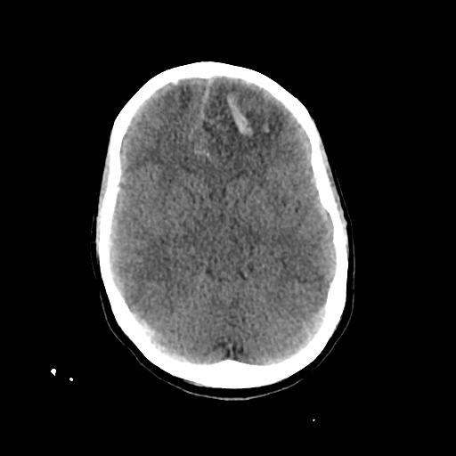 Cerebral venous throbmosis - hemorrhagic venous infarction (Radiopaedia 87318-103613 Axial non-contrast 69).jpg