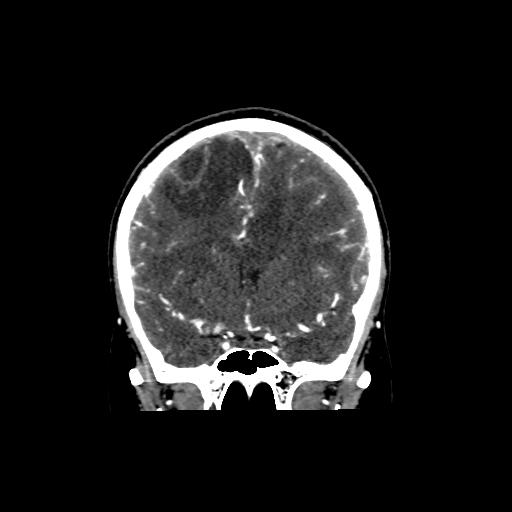 File:Cerebral venous throbmosis - hemorrhagic venous infarction (Radiopaedia 87318-103613 Coronal CT venogram 12).jpg