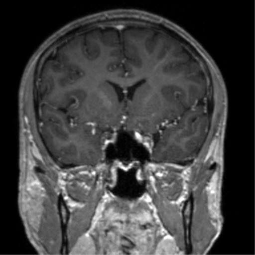 Cerebral venous thrombosis (Radiopaedia 38392-40469 Coronal T1 C+ 56).png