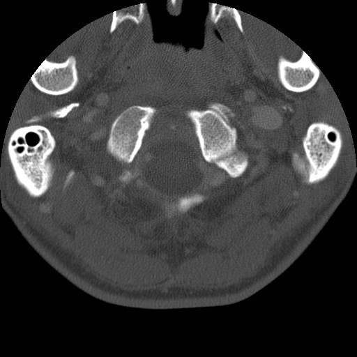 Cervical Pott disease (Radiopaedia 20374-20286 Axial bone window 14).jpg