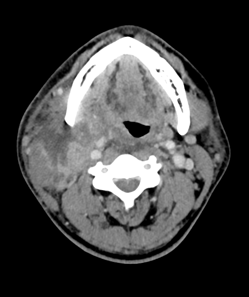 Cervical abscess (Radiopaedia 43725-47184 A 28).png