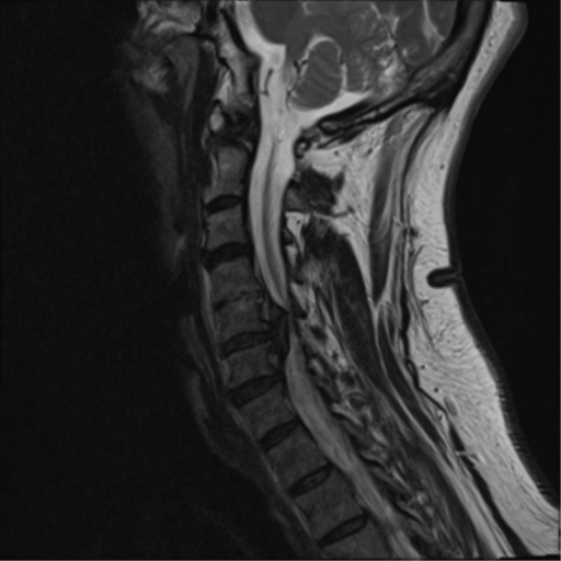 File:Cervical canal stenosis due to ossification of the posterior longitudinal ligament (Radiopaedia 47260-51824 Sagittal T2 10).png