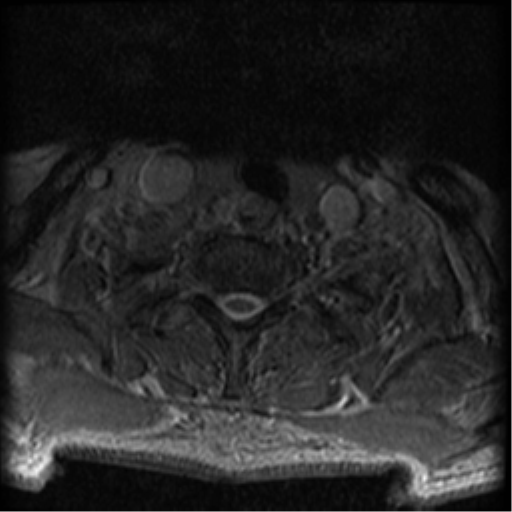 Cervical canal stenosis with cord compression (Radiopaedia 34114-35374 Axial Gradient Echo 11).png