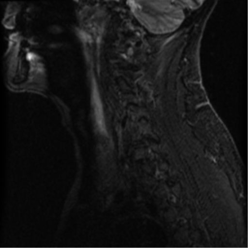 File:Cervical canal stenosis with cord compression (Radiopaedia 34114-35374 Sagittal STIR 2).png
