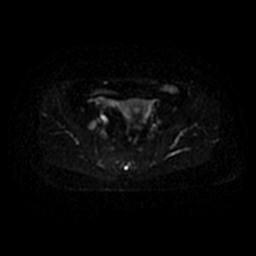 File:Cervical carcinoma (Radiopaedia 67644-77047 Axial DWI 32).jpg