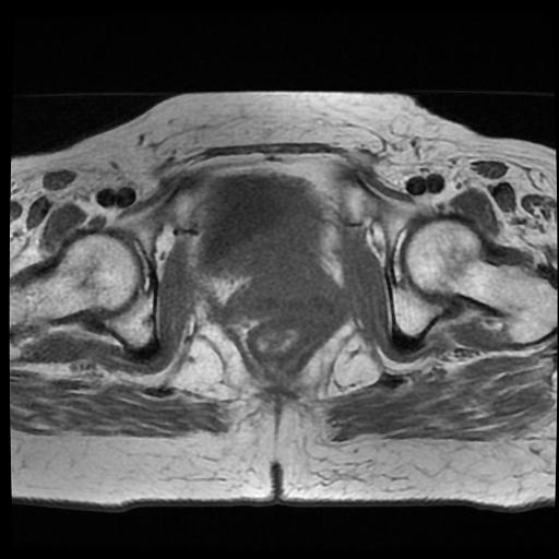 File:Cervical carcinoma (Radiopaedia 70924-81132 Axial T1 14).jpg