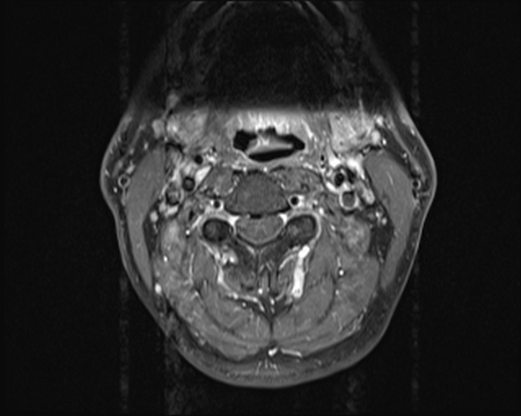 File:Cervical disc extrusion (Radiopaedia 53950-60077 Axial T1 C+ fat sat 4).jpg