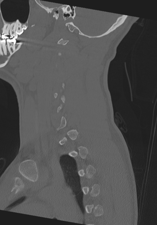 Cervical intercalary bone (Radiopaedia 35211-36748 Sagittal bone window 21).png