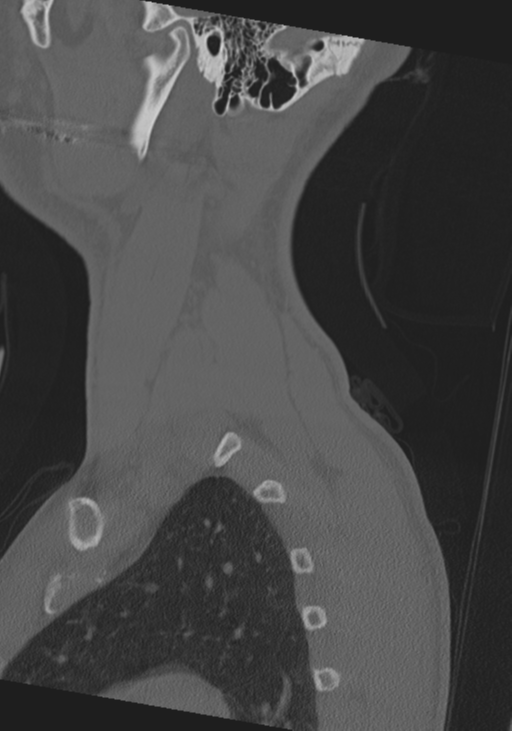 Cervical intercalary bone (Radiopaedia 35211-36748 Sagittal bone window 7).png