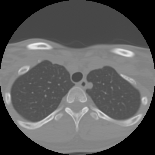 Cervical rib (Radiopaedia 71110-81363 Axial non-contrast 56).jpg