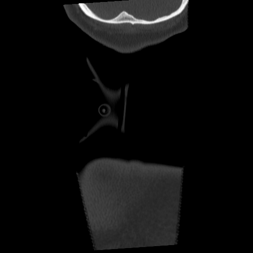 Cervical schwannoma (Radiopaedia 57979-64974 Coronal bone window 68).png