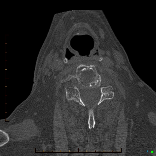 Cervical spine fracture - ankylosing spondylitis (Radiopaedia 76835-88706 Axial bone window 140).jpg