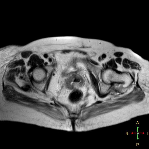 File:Cervical stump squamous cell carcinoma (Radiopaedia 48049-52858 Axial T2 3).jpg