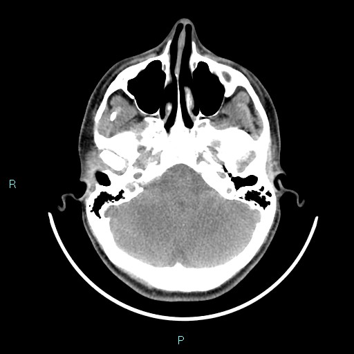 File:Cervical thymic cyst (Radiopaedia 88632-105335 Axial non-contrast 110).jpg