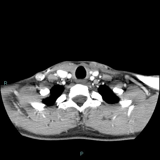 Cervical thymic cyst (Radiopaedia 88632-105335 B 34).jpg