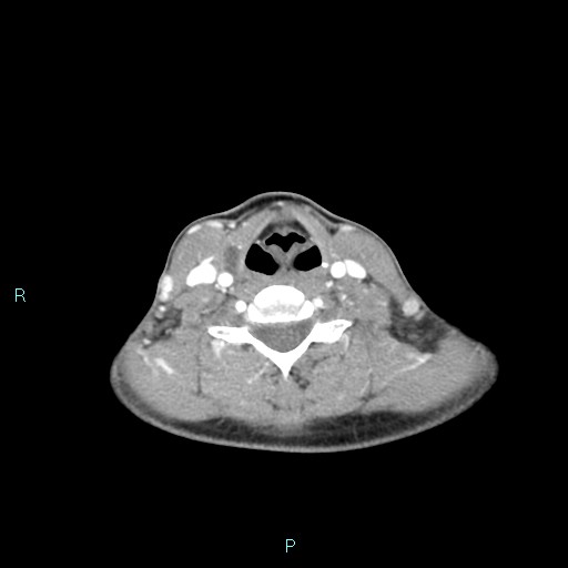 Cervical thymic cyst (Radiopaedia 88632-105335 B 50).jpg