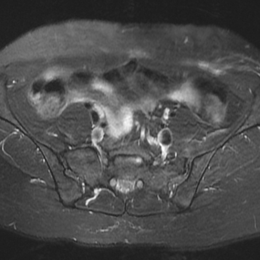 File:Cesarian section scar endometriosis (Radiopaedia 66520-75799 Axial T2 fat sat 1).jpg