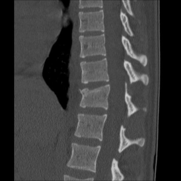 Chance fracture (Radiopaedia 36521-38081 Sagittal bone window 29).jpg