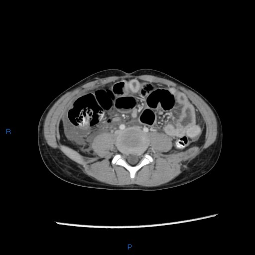File:Chance fracture with duodenal and pancreatic lacerations (Radiopaedia 43477-46864 A 34).jpg