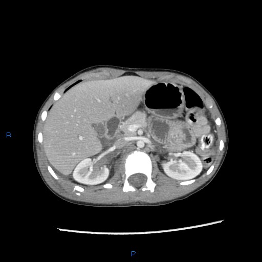 File:Chance fracture with duodenal and pancreatic lacerations (Radiopaedia 43477-46864 A 6).jpg