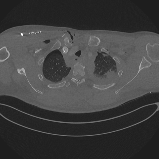 Chest multitrauma - aortic injury (Radiopaedia 34708-36147 Axial bone window 54).png
