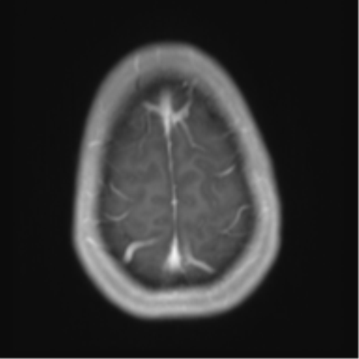 File:Chiari I malformation and obstructive hydrocephalus (Radiopaedia 41185-43978 Axial T1 C+ 28).png
