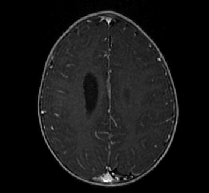Chiasmatic-hypothalamic glioma (Radiopaedia 90079-107252 Axial T1 C+ 64).jpg