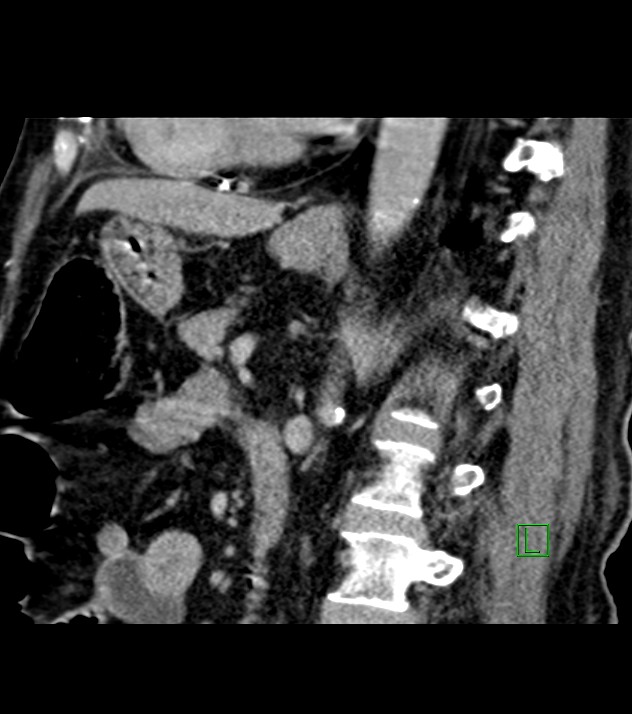 Cholangiocarcinoma with cerebral metastases (Radiopaedia 83519-98629 Sagittal C+ delayed 48).jpg