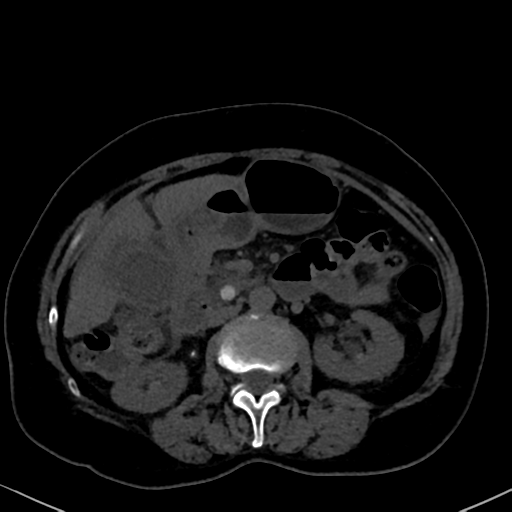 File:Cholecystitis - obstructive choledocholitiasis (CT intravenous cholangiography) (Radiopaedia 43966-47479 Axial 110).png