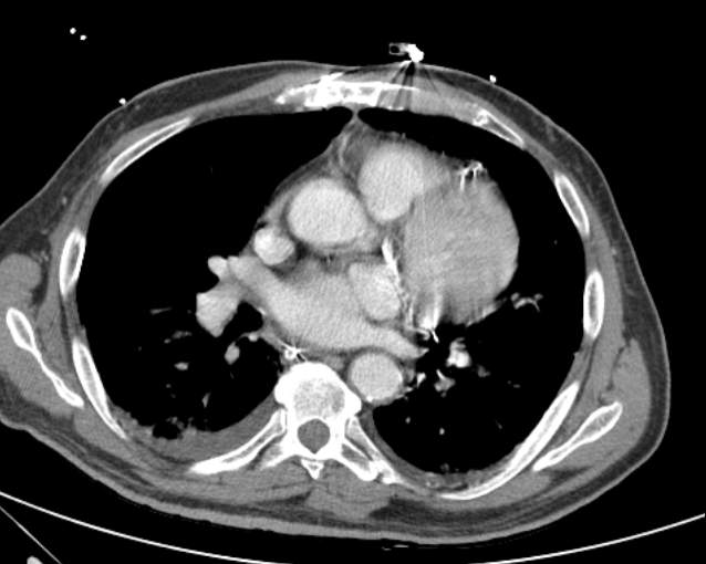 Cholecystitis - perforated gallbladder (Radiopaedia 57038-63916 A 1).jpg