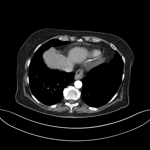 Cholecystoduodenal fistula due to calculous cholecystitis with gallstone migration (Radiopaedia 86875-103077 A 9).jpg