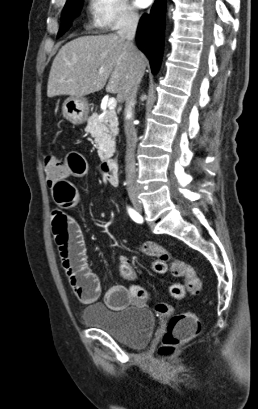 Cholecystoduodenal fistula due to calculous cholecystitis with gallstone migration (Radiopaedia 86875-103077 C 34).jpg