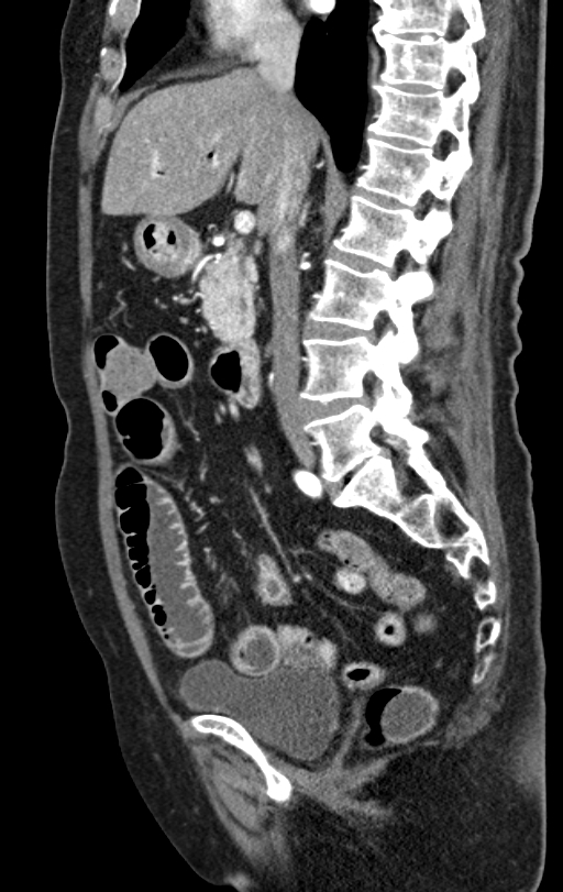 Cholecystoduodenal fistula due to calculous cholecystitis with gallstone migration (Radiopaedia 86875-103077 C 35).jpg