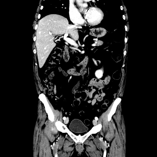Choledocholiathiasis with normal caliber common bile duct (Radiopaedia 75368-86632 Coronal liver window 59).jpg