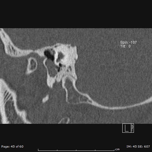Cholesteatoma - external auditory canal (Radiopaedia 88452-105096 Sagittal bone window 45).jpg