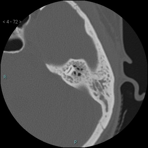File:Cholesterol granuloma of the petrous apex (Radiopaedia 64358-73141 Axial bone window 35).jpg