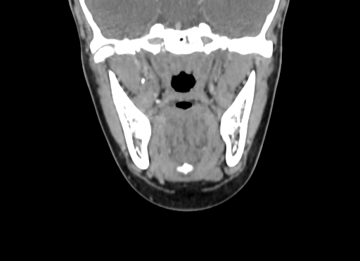 Chondroblastic osteosarcoma (Radiopaedia 67363-76741 D 56).jpg